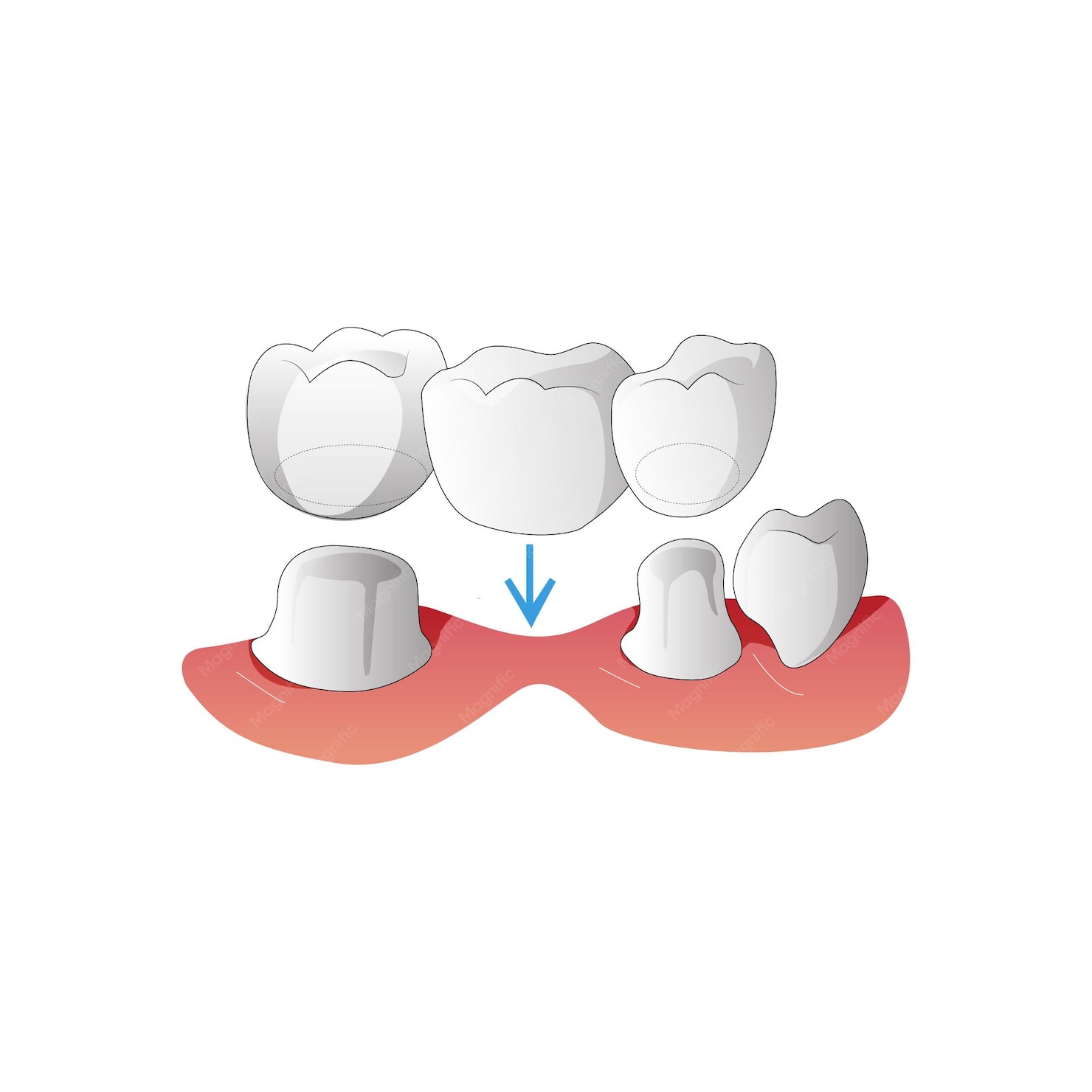 Dental Bridges in Markham, ON
