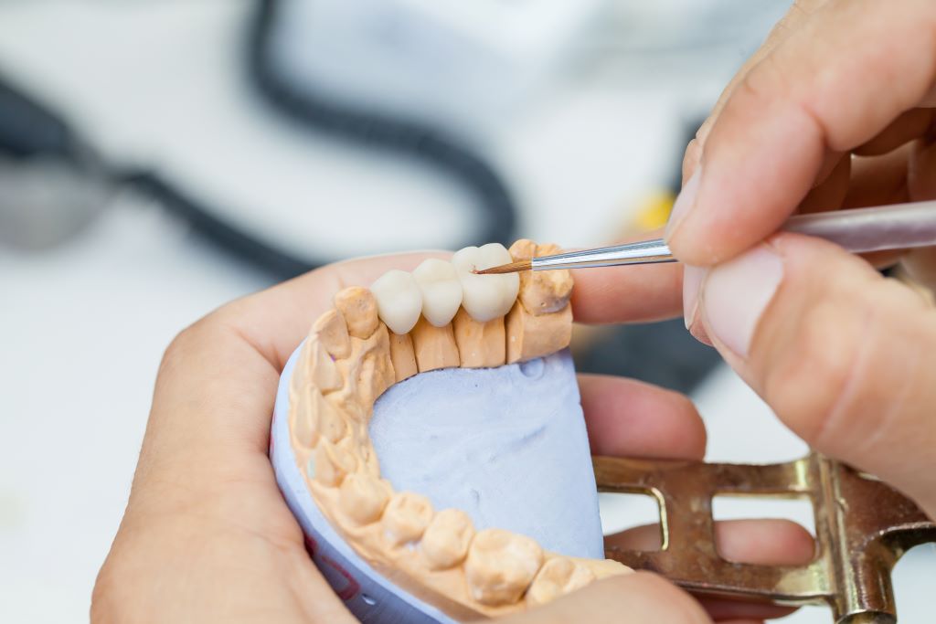 dental bridges near you