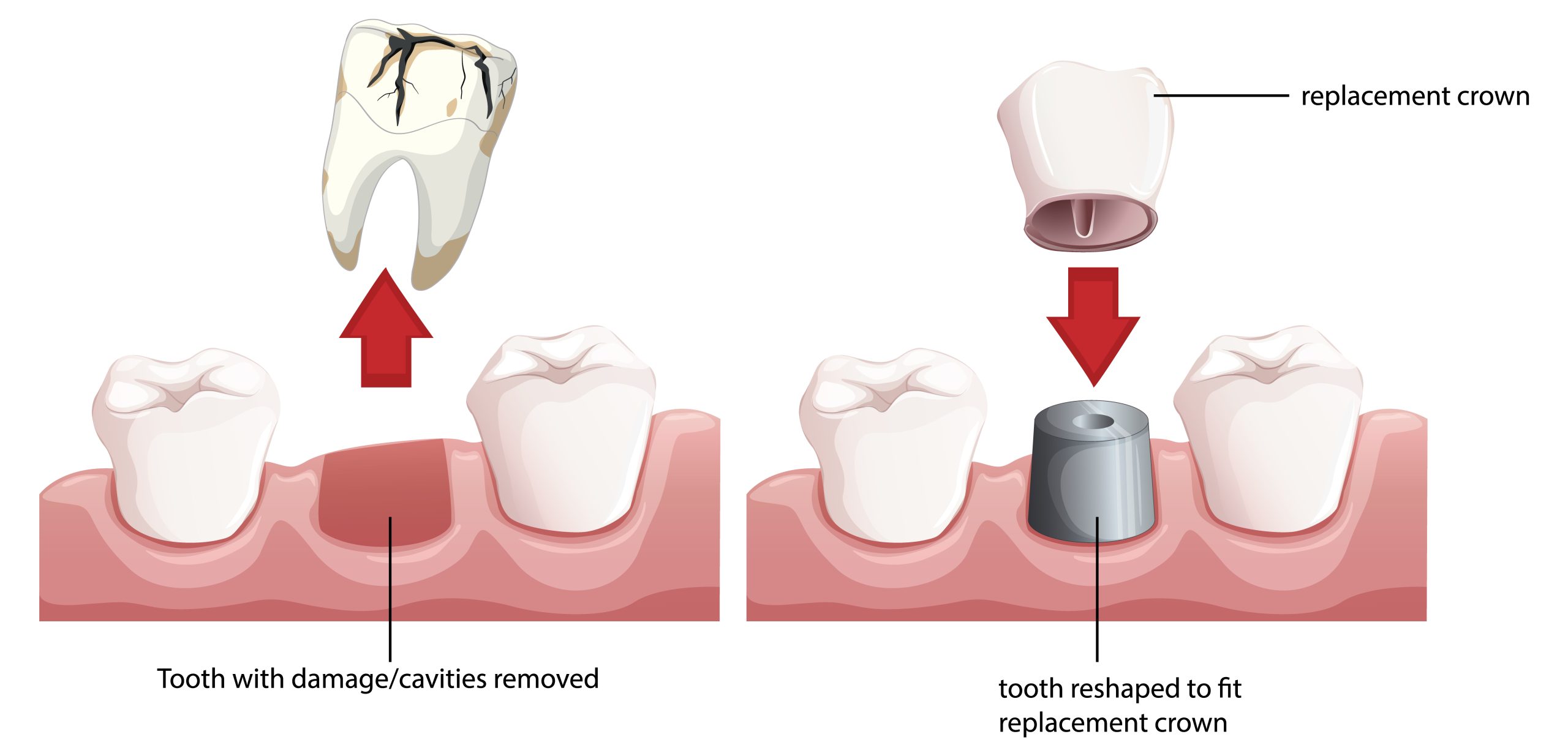 Dental Crowns in Markham, ON
