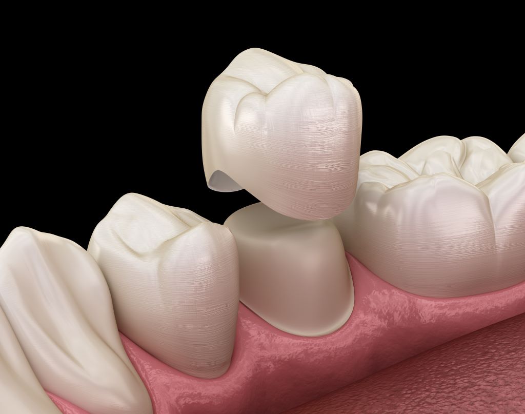 dental crowns markham