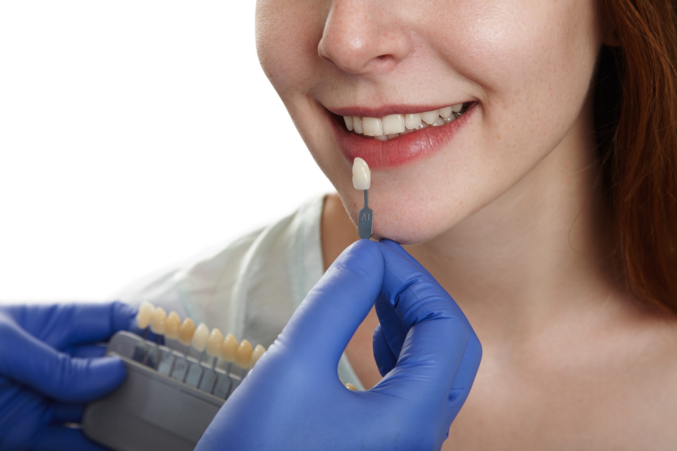 Porcelain Veneers in Markham, ON