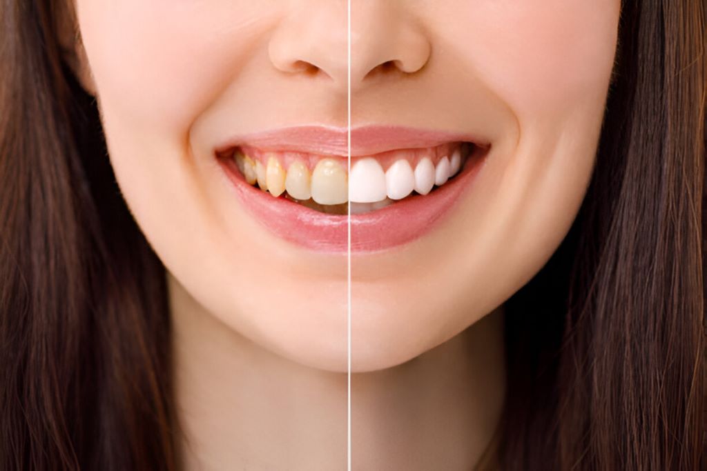 teeth whitening markham