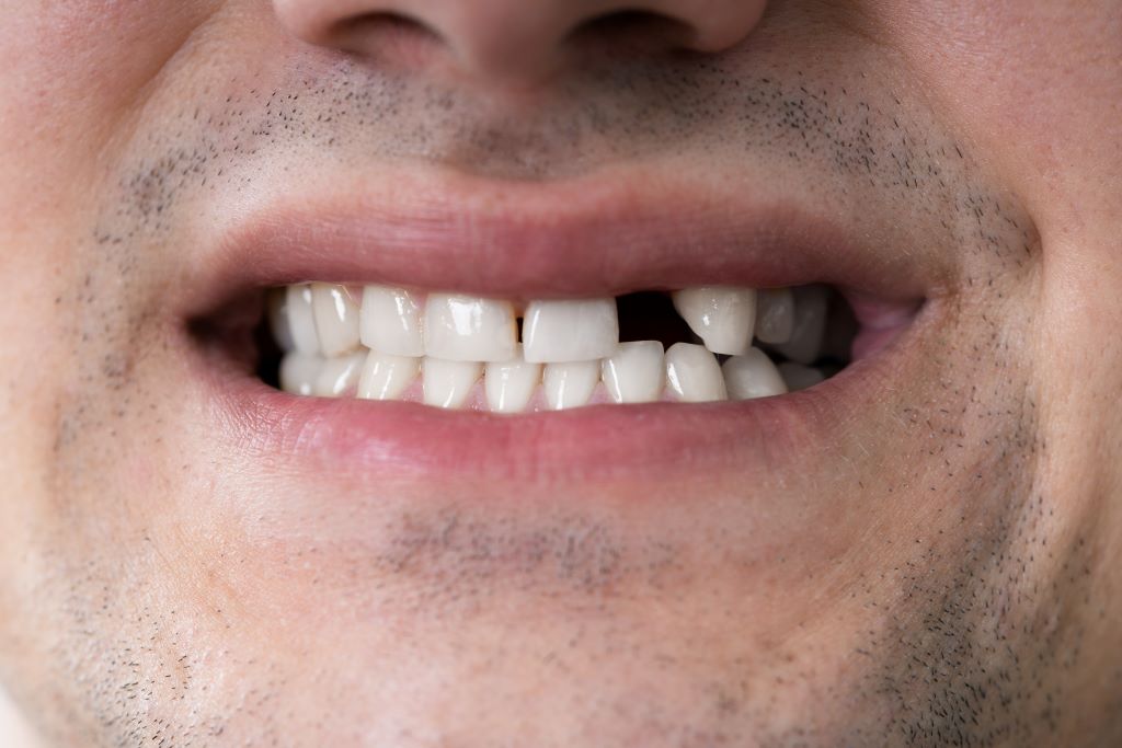 tooth extractions in markham