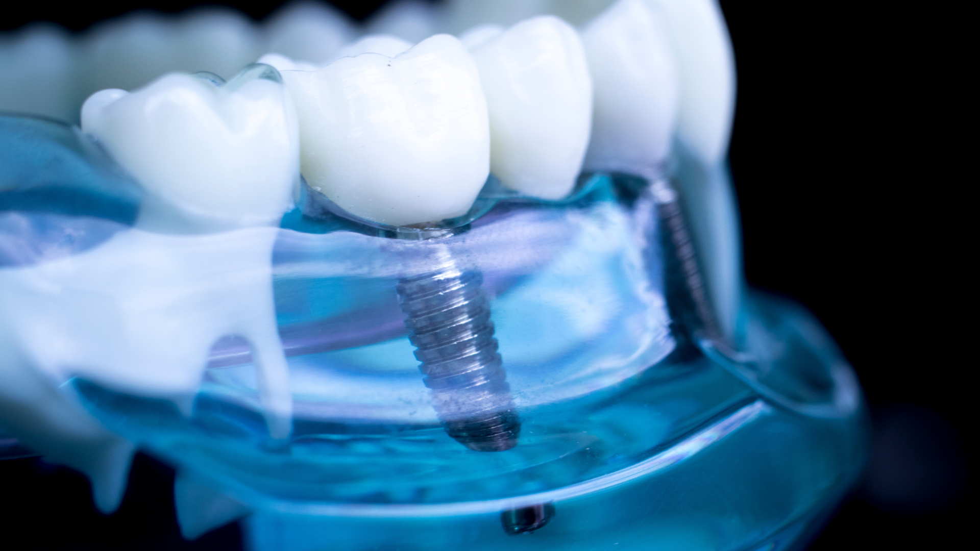 dental implants