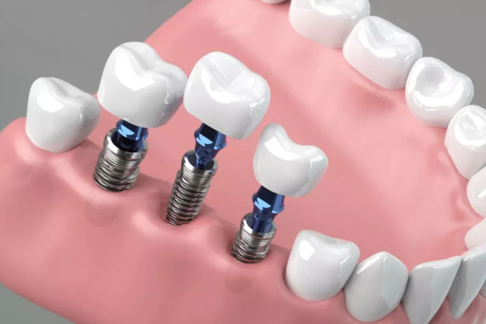 Replace missing teeth with dental implants in Markham. Enjoy a natural look, strong bite, and long-lasting smile