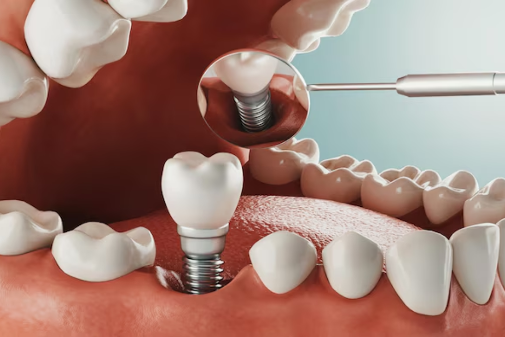 Looking for dental implants in Markham or dental implants near me? Get lasting, natural-looking dental implants with expert care. Book your consultation today!