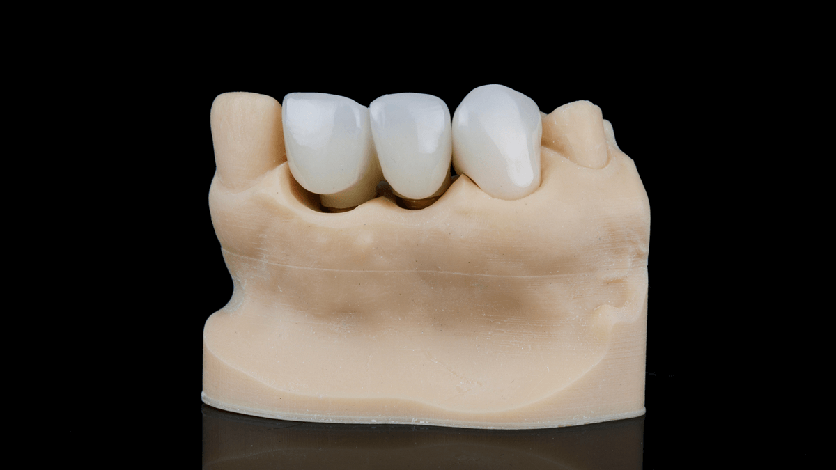 Dental Bridges